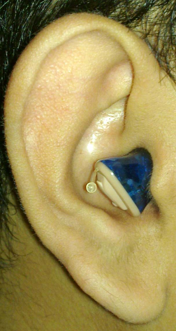 Widex Hearing Aid large image 0